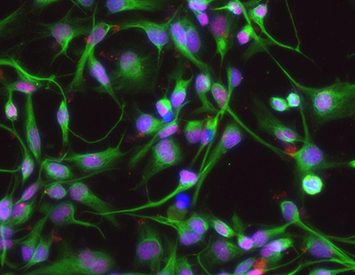 Cells isolated from a child with high grade glioma. SOX2 a key stem cell-associated transcription factor is in red, nuclei stained in blue and a neural stem cell marker (Nestin) shown in green. Image courtesy of Raul Bressan.